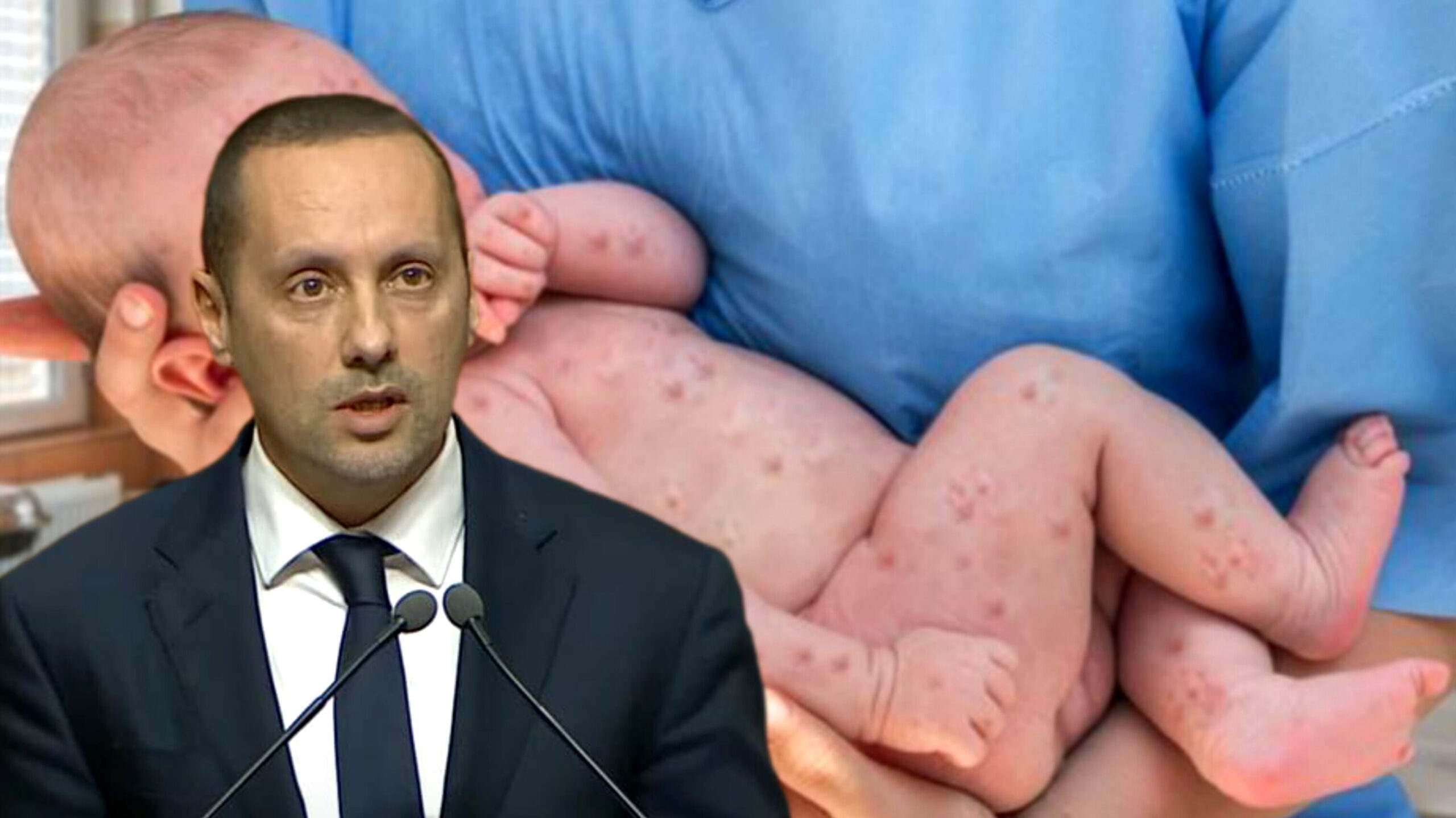 حصيلة مقلقة لمرض بوحمرون بالمغرب: وزير الصحة يكشف عن 107 حالات وفاة وأسباب الانتشار